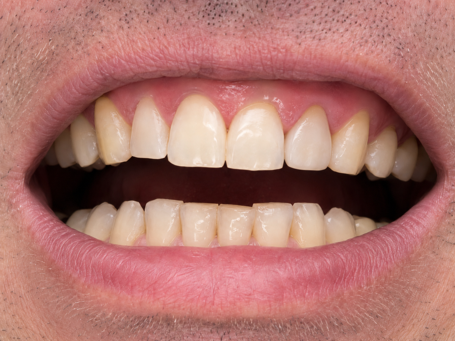 Dental Crown — after