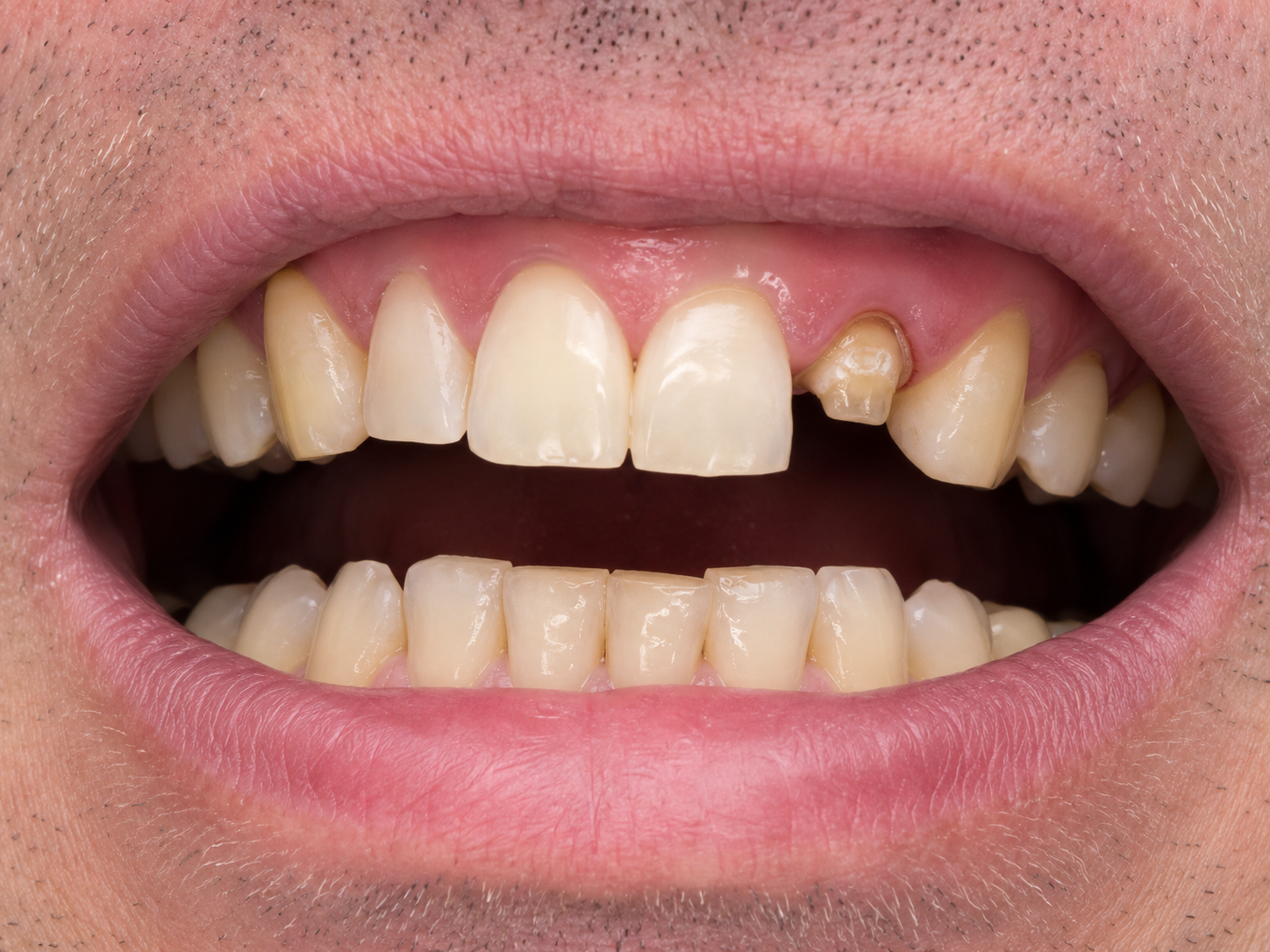 Dental Crown — before