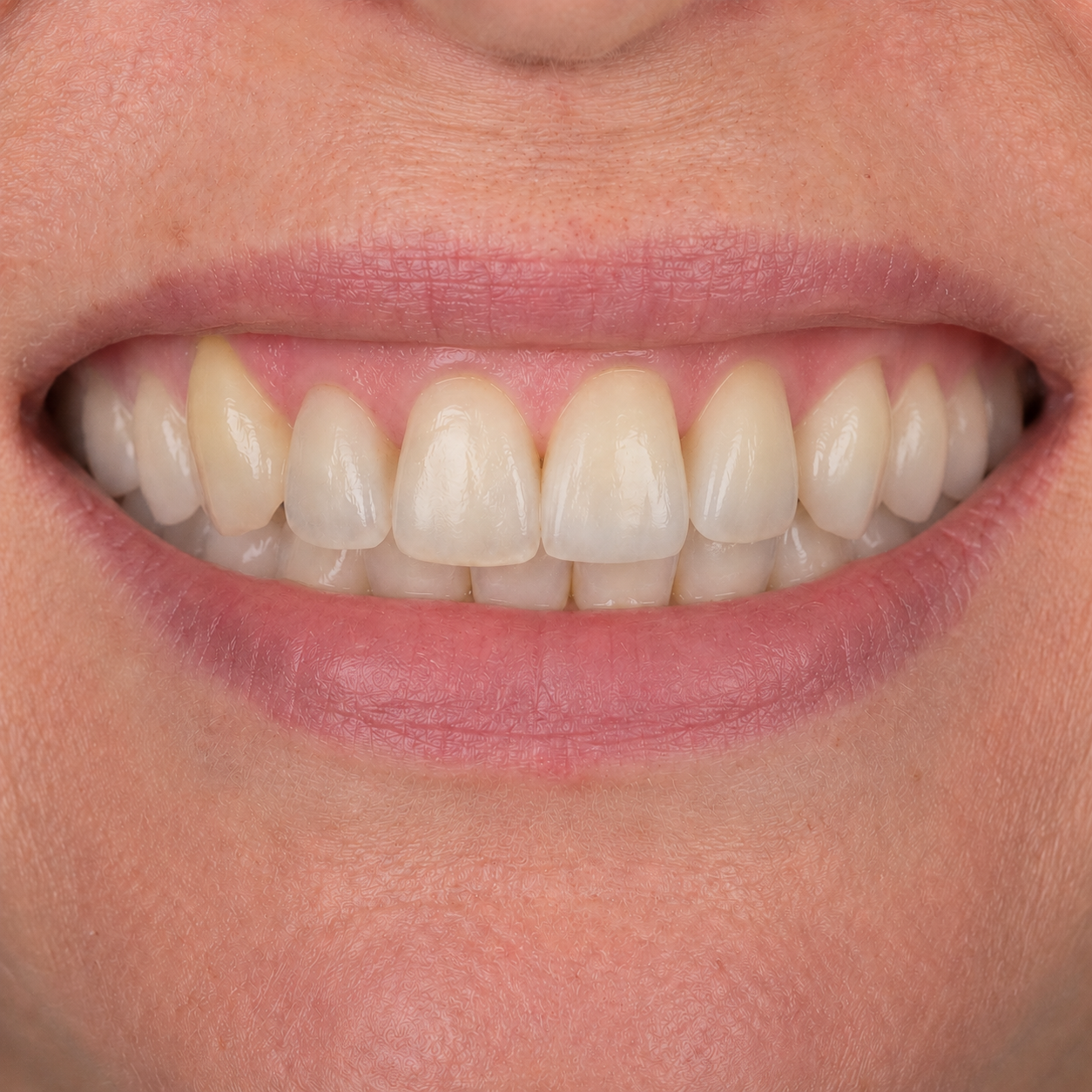 Single Dental Implant — after