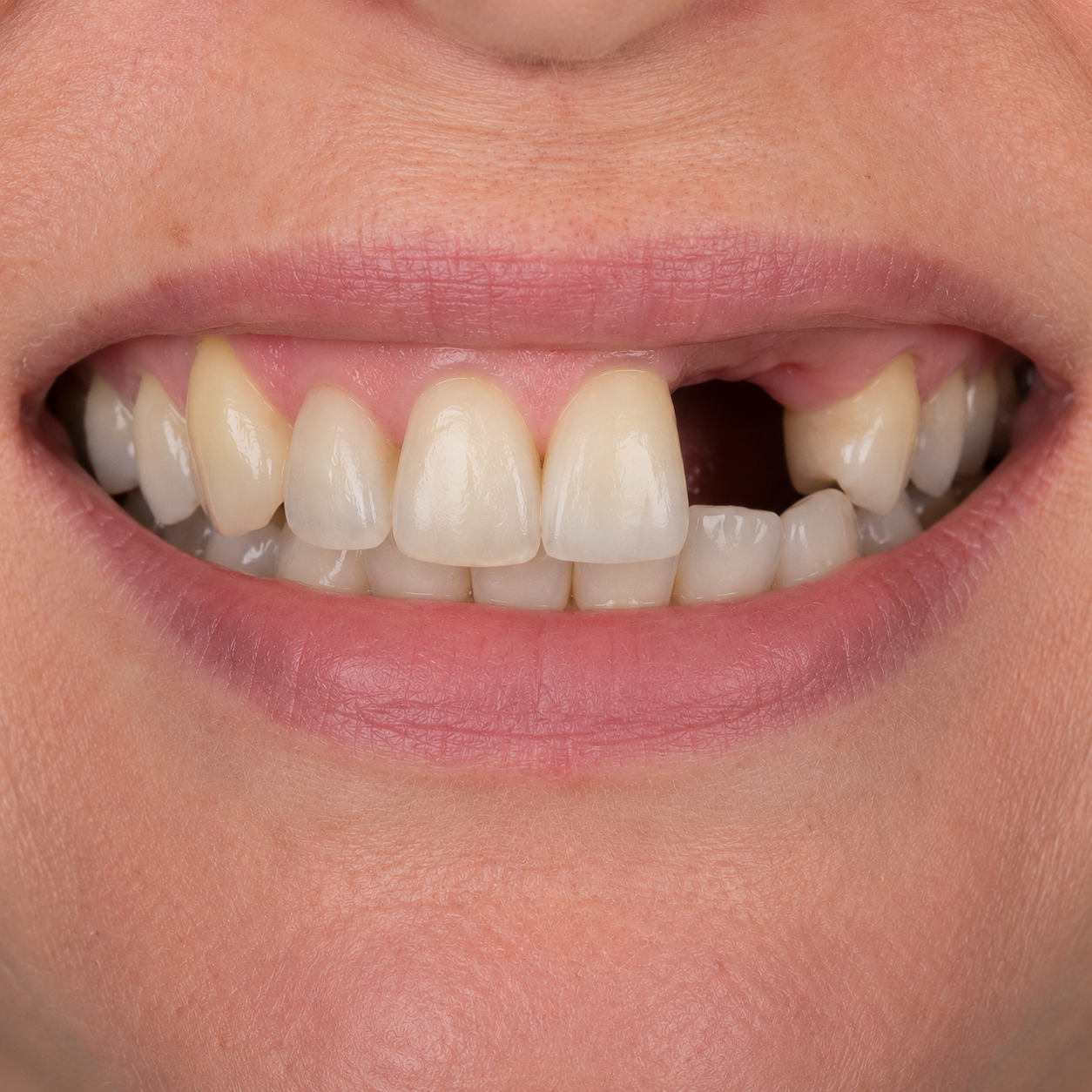 Single Dental Implant — before